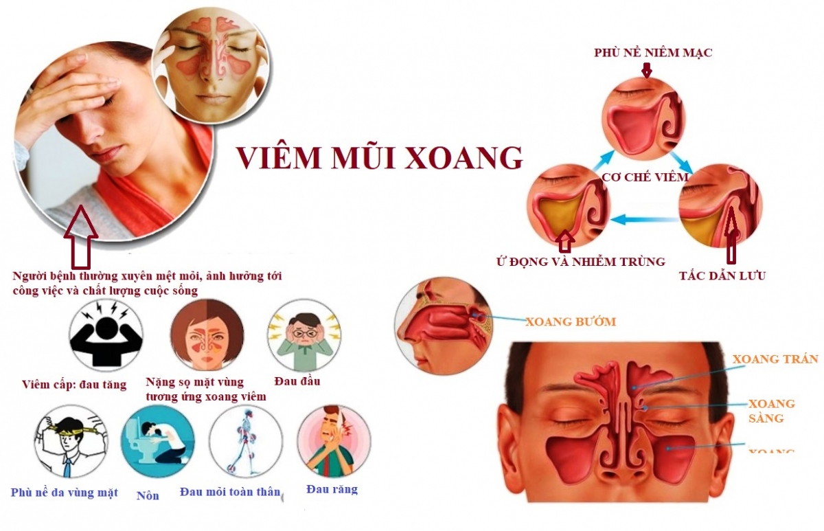 Các thói quen xấu dễ dẫn đến viêm mũi xoang